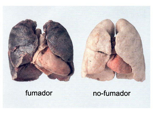 cigarrillo - cáncer